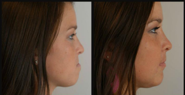 Lincoln NE Oral Surgery Woman Before & After Jaw Surgery