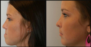 Lincoln NE Oral Surgery - Corrective Jaw Surgery Female Patient with Dark Hair Before and After Close Up