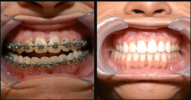 Lincoln NE Oral Surgery - Corrective Jaw Surgery Before and After Close Up 4