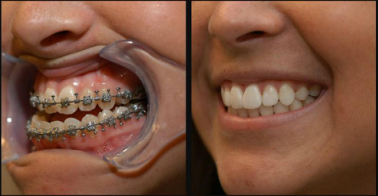 Lincoln NE Oral Surgery - Corrective Jaw Surgery Patient With Smile Before and After Close Up