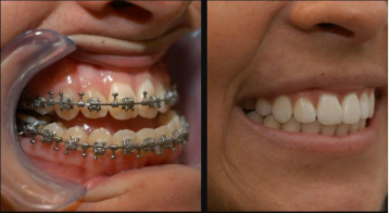 Lincoln NE Oral Surgery - Corrective Jaw Surgery Before and After Close Up