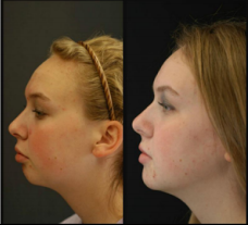 Lincoln NE Oral Surgery - Corrective Jaw Surgery Young Female Patient Before and After Close Up