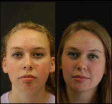 Lincoln NE Oral Surgery - Correct Jaw Before and After