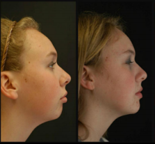 Lincoln NE Oral Surgery - Corrective Jaw Surgery Before and After Young Female Patient