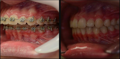 Lincoln NE Oral Surgery - Corrective Jaw Surgery Before and After Close Up 8