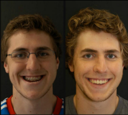 Lincoln NE Oral Surgery - Correct Jaw Young Male Patient Before and After