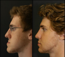 Lincoln NE Oral Surgery Before and After Jaw Surgery