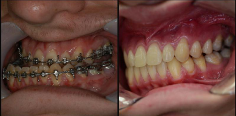 Lincoln NE Oral Surgery - Corrective Jaw Surgery Before and After Close Up