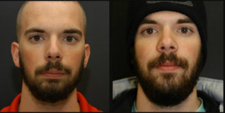 Lincoln NE Oral Surgery - Corrective Jaw Surgery Male Patient with Beard Before and After Close Up