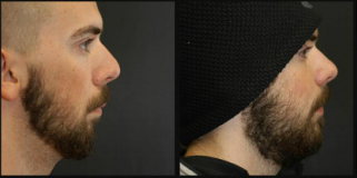 Lincoln NE Oral Surgery - Correct Jaw Patient With Beard Before and After