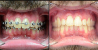 Lincoln NE Oral Surgery - Correct Jaw Male Patient With Mustache Before and After