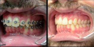 Lincoln NE Oral Surgery - Corrective Jaw Surgery Before and After Close Up Male Patient with Mustache