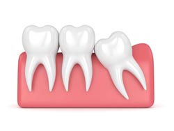 Lincoln NE Oral Surgery Inverted Tooth
