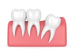 Lincoln NE Oral Surgery Wisdom Teeth Showing