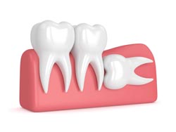 Lincoln NE Oral Surgery Wisdom Teeth