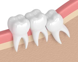 Lincoln NE Oral Surgery Inverted Tooth Diagram