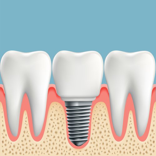3d dental implant