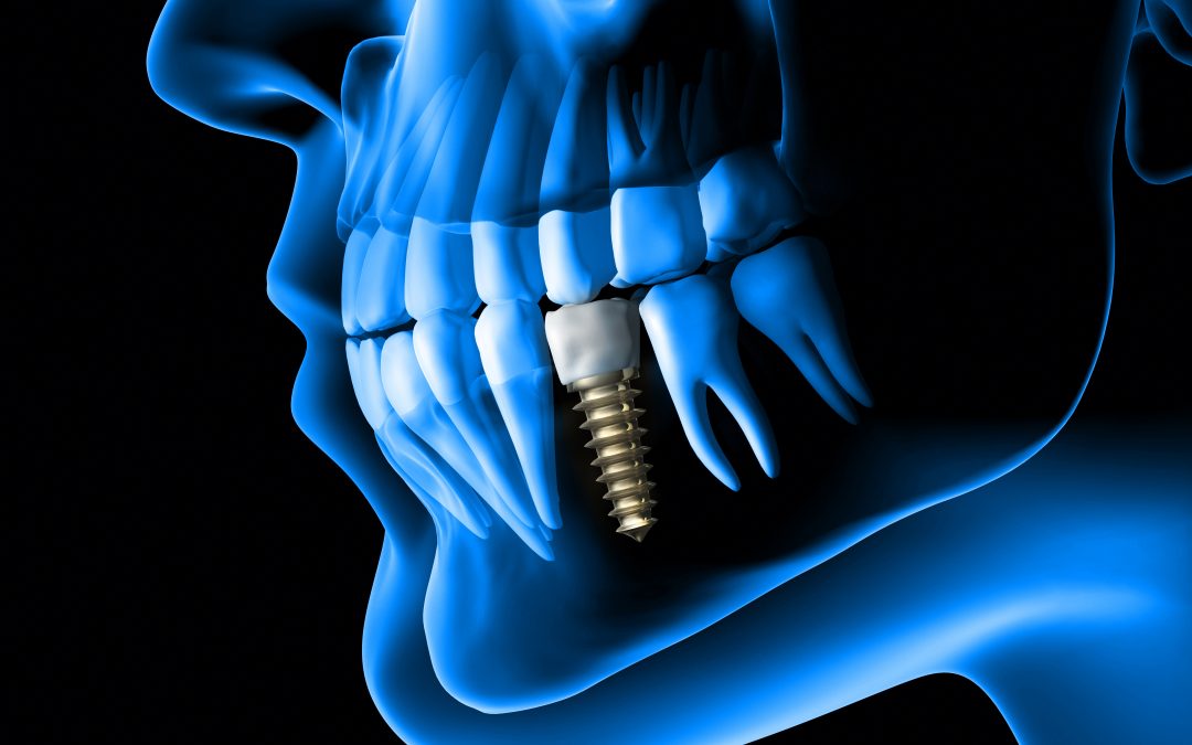 Lincoln NE Oral Surgery X-ray Tooth