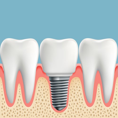 dental implants lincoln ne