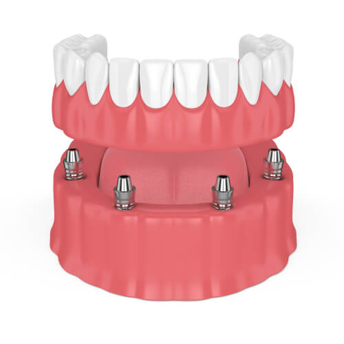 reconstruction surgery full arch dental implants lincoln ne